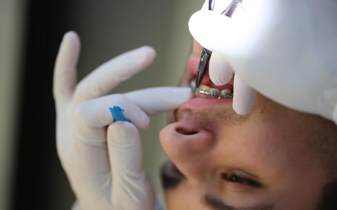 Remoção do aparelho dentário antes do tempo