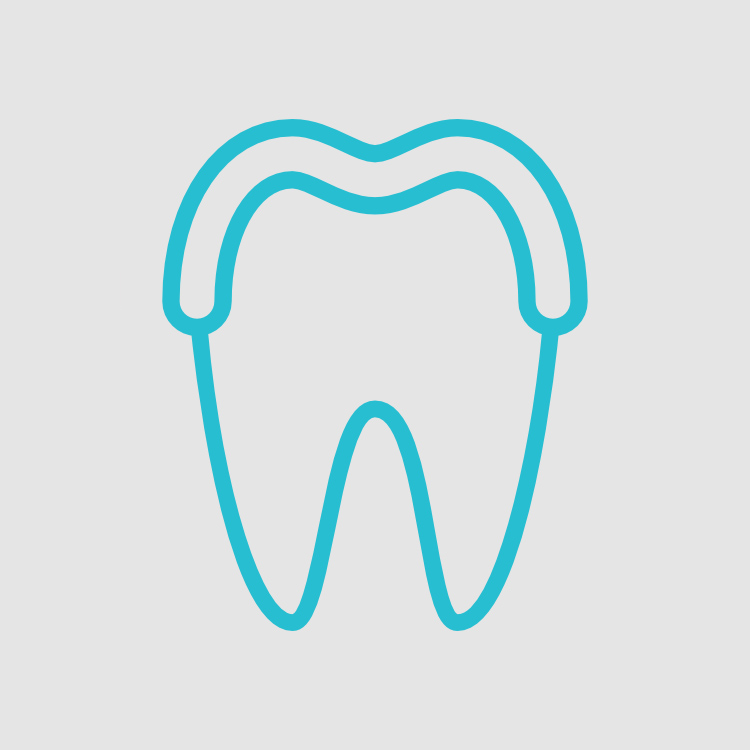 Restaurações feitas em laboratório indicadas para dentes que necessitam de recobrimento total ou parcial de cúspides.