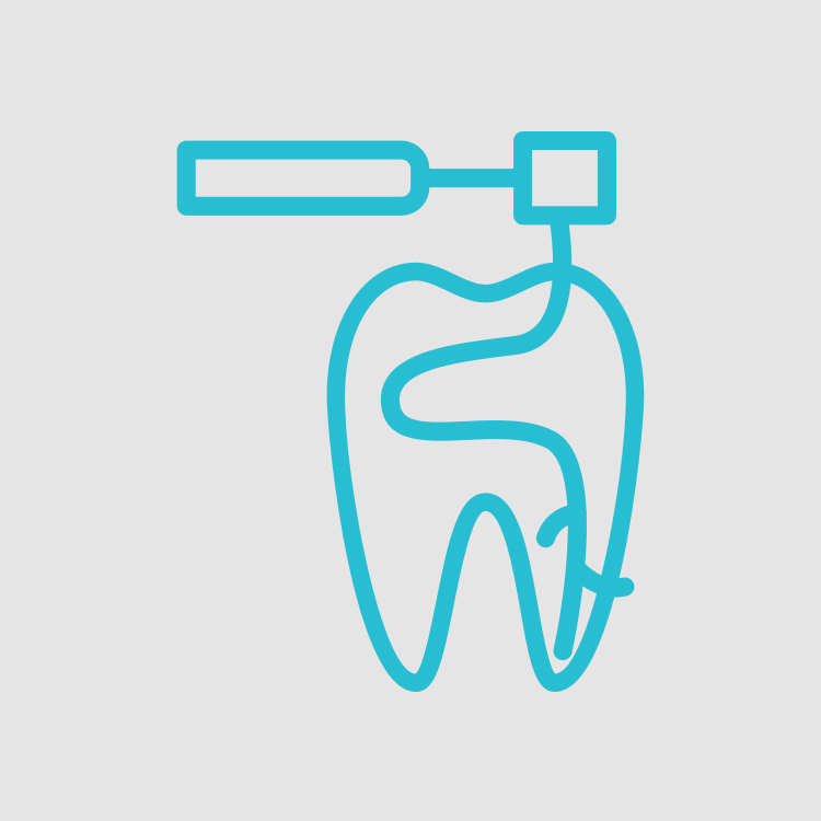 Remoção da polpa dentária (nervos e vasos dentro do dente), na desinfeção e preenchimento com material compatível.