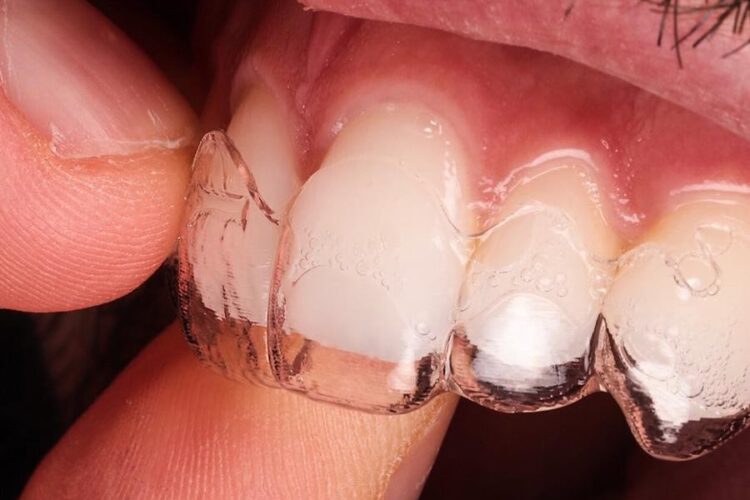 SINTA-SE MAIS CONFIANTE COM O SEU SORRISO – INVISALIGN