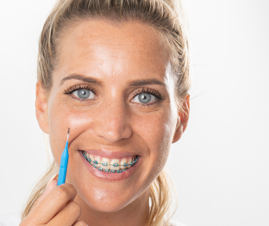 O uso do aparelho dentário obriga a alguns cuidados com a alimentação. Damos algumas dicas de alimentos a evitar durante o aparelho dentário.