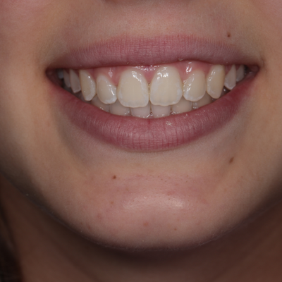 Ortodontia - Dra. Marisa Sousa - Depois
