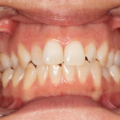 Ortodontia - Dr. Vando Neto - Antes