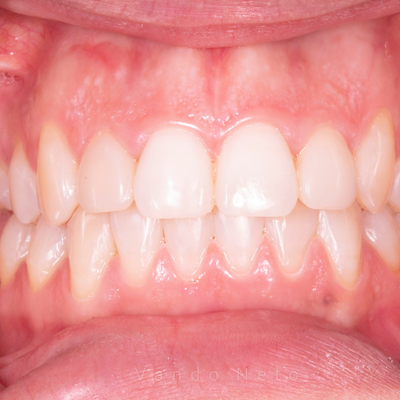 Ortodontia - Dr. Vando Neto - Depois