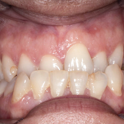 Ortodontia - Dr. Vando Neto - Antes