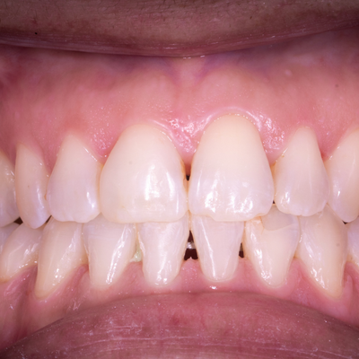 Ortodontia - Dr. Vando Neto - Depois