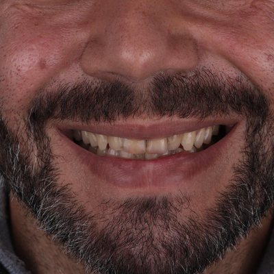 Estética Dentária - Dr. Nuno Correia Antes