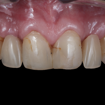 Estética Dentária - Dr. Nuno Correia - Antes