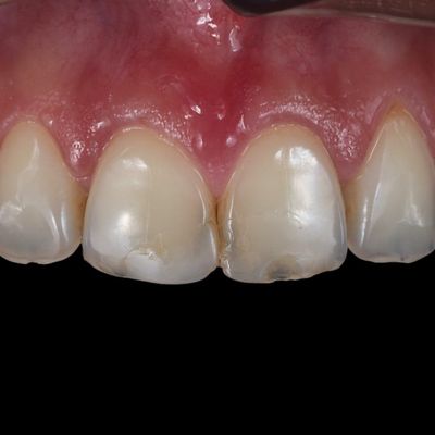 Estética dentária - Dr. Nuno Correia - Antes
