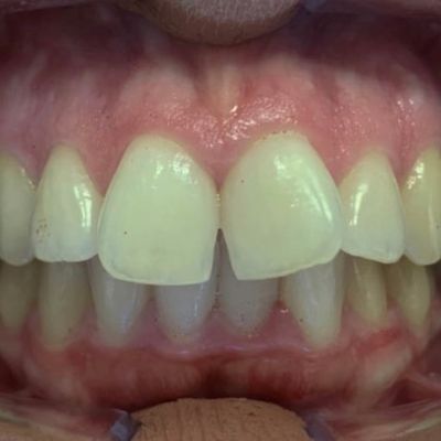Ortodontia - Dra. Flávia Farinha - Antes