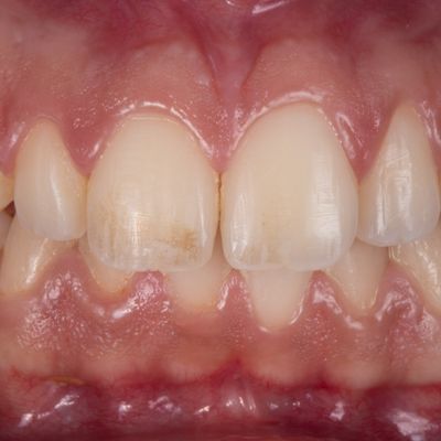 Estética dentária - Dr. Carlos Américo - Antes