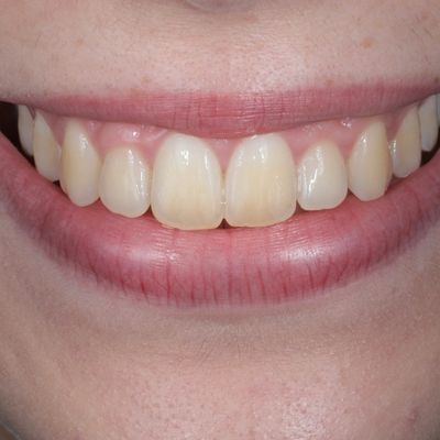 Branqueamento dentário externo - Dr. Nuno Correia - Antes