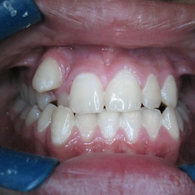 Ortodontia | Ortopedia Facial Funcional - Dra. Elsa Pita - Antes