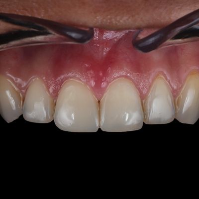 Estética dentária - Dr. Nuno Correia - Depois