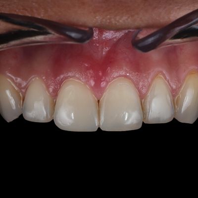 Estética dentária - Dr. Nuno Correia - Depois