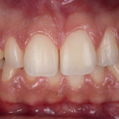 Estética dentária - Dr. Carlos Américo - Depois