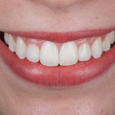 Branqueamento dentário externo - Dr. Nuno Correia - Depois