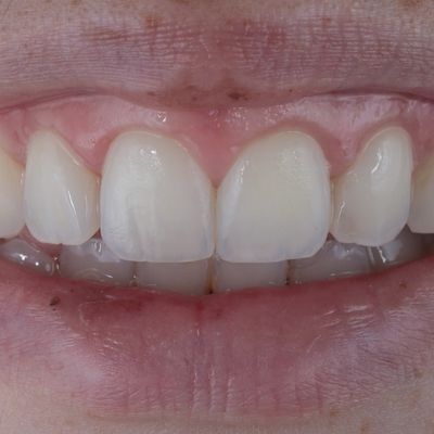 Branqueamento dentário interno - Dr. Nuno Correia - Depois