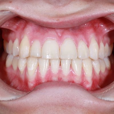 Ortodontia | Ortopedia Facial Funcional - Dra. Elsa Pita - Depois