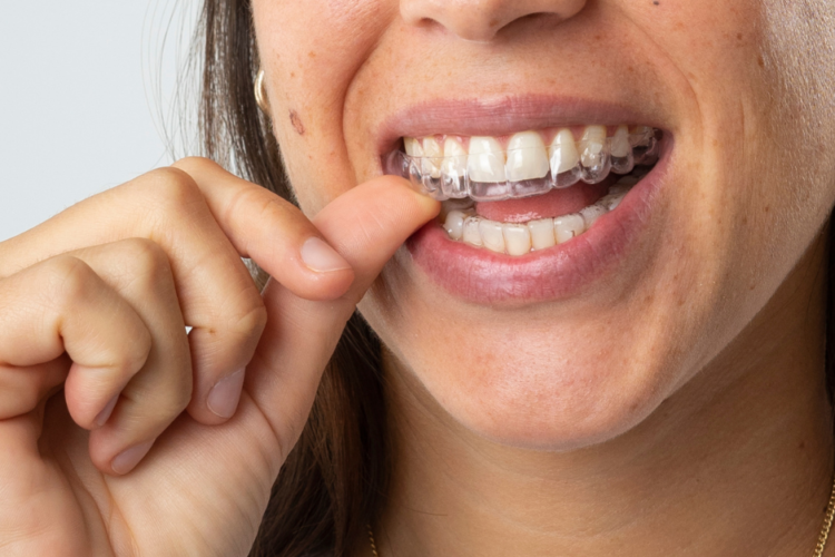 Os alinhadores são a mais recente evolução tecnológica ortodôntica que permite o alinhamento dos dentes de uma forma estética e confortável para o paciente.