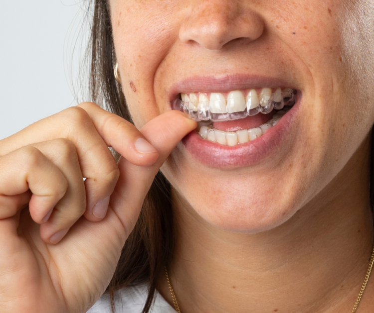 Os alinhadores são a mais recente evolução tecnológica ortodôntica que permite o alinhamento dos dentes de uma forma estética e confortável para o paciente.