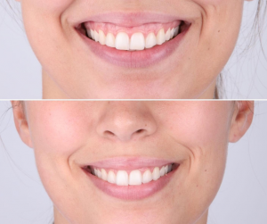 "gummy smile" is used to describe excessive gum exposure during smiling. Although it does not pose oral health risks, this issue can cause aesthetic discomfort by compromising facial harmony and symmetry.